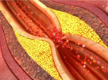 Digital Highlights Hub Card Coronary Artery Disease.jpg